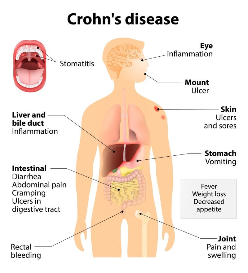diagram highlighting symptoms crohns disease